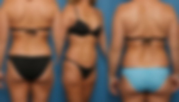 Transformez votre silhouette avec la liposuccion à marseille